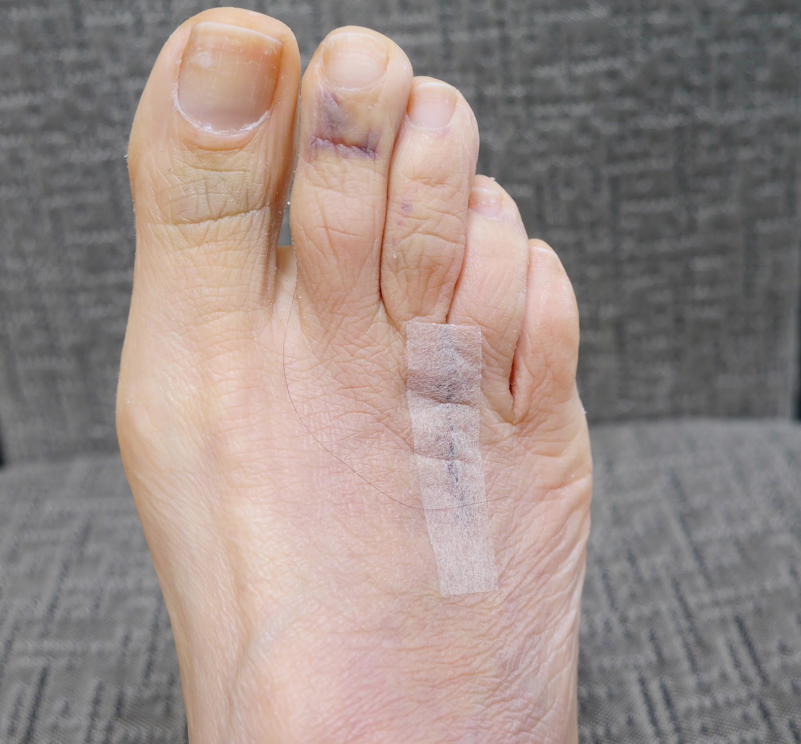 What are some effective treatments for Morton's neuroma?